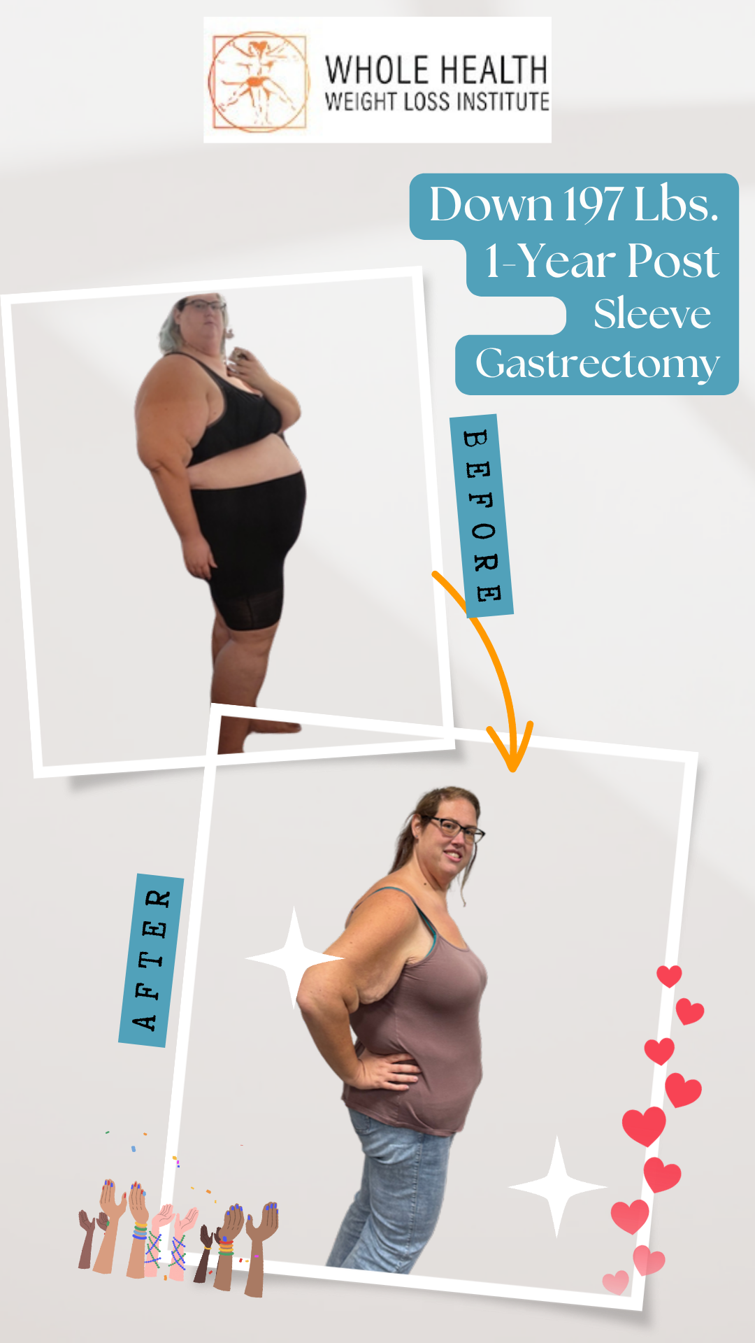 Before and after photos of Amanda showing 197 lbs weight loss after gastric sleeve surgery at Whole Health Weight Loss Institute