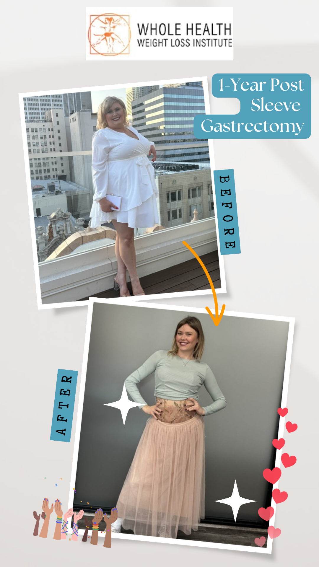 Before and after photos of Hannah showing 111 lbs weight loss after gastric sleeve surgery at Whole Health Weight Loss Institute