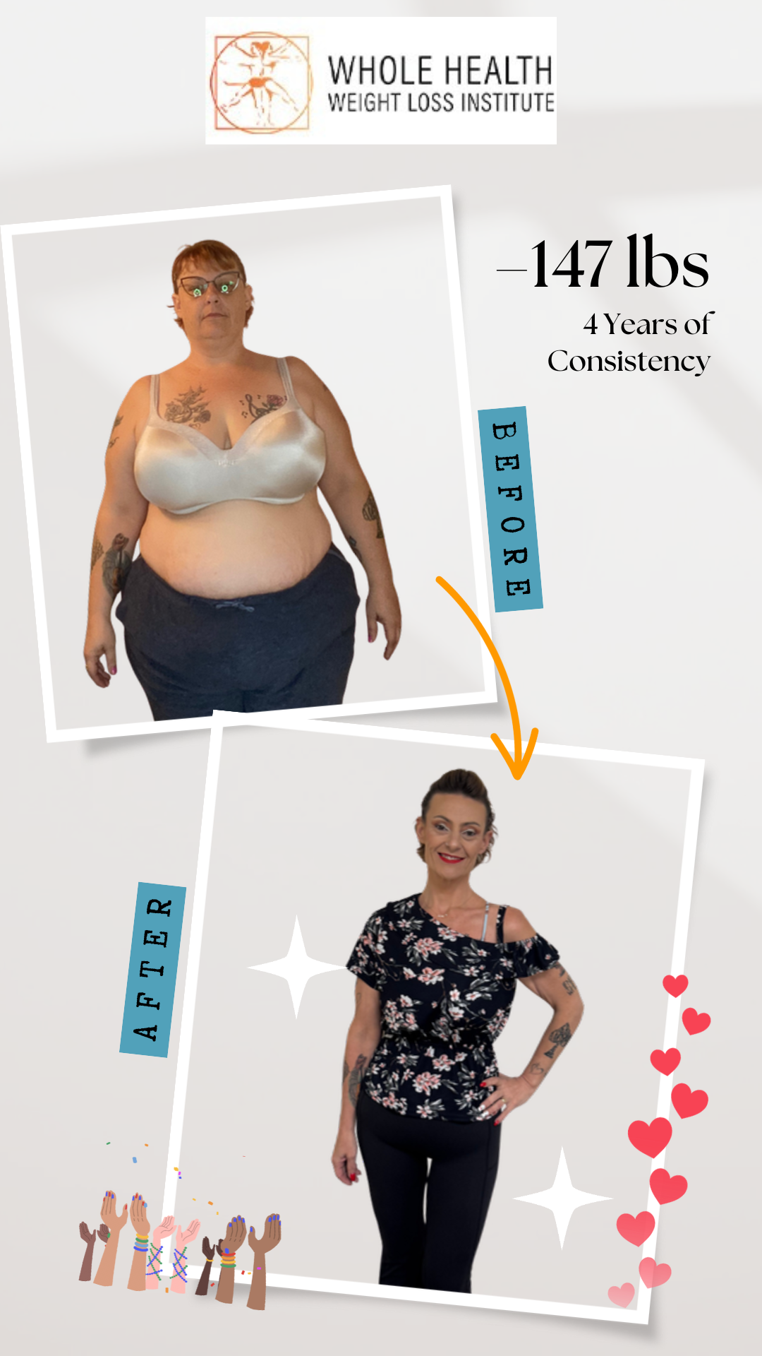 Before and after photos of Melissa showing 147 lbs weight loss after gastric sleeve surgery at Whole Health Weight Loss Institute