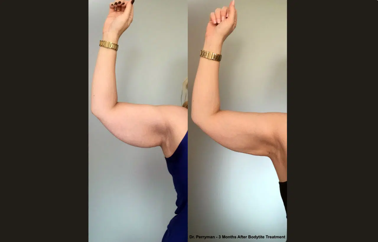 FaceTite before-and-after result