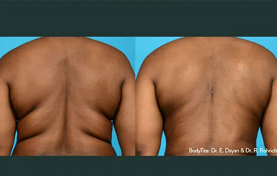 FaceTite before-and-after result