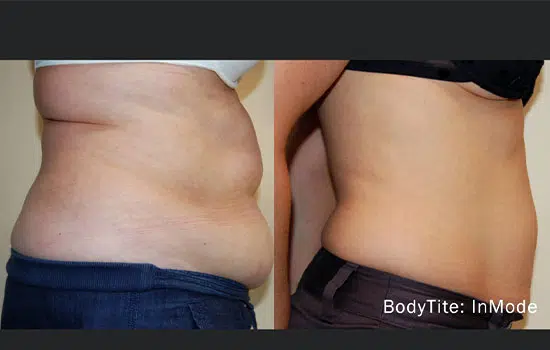 FaceTite before-and-after result