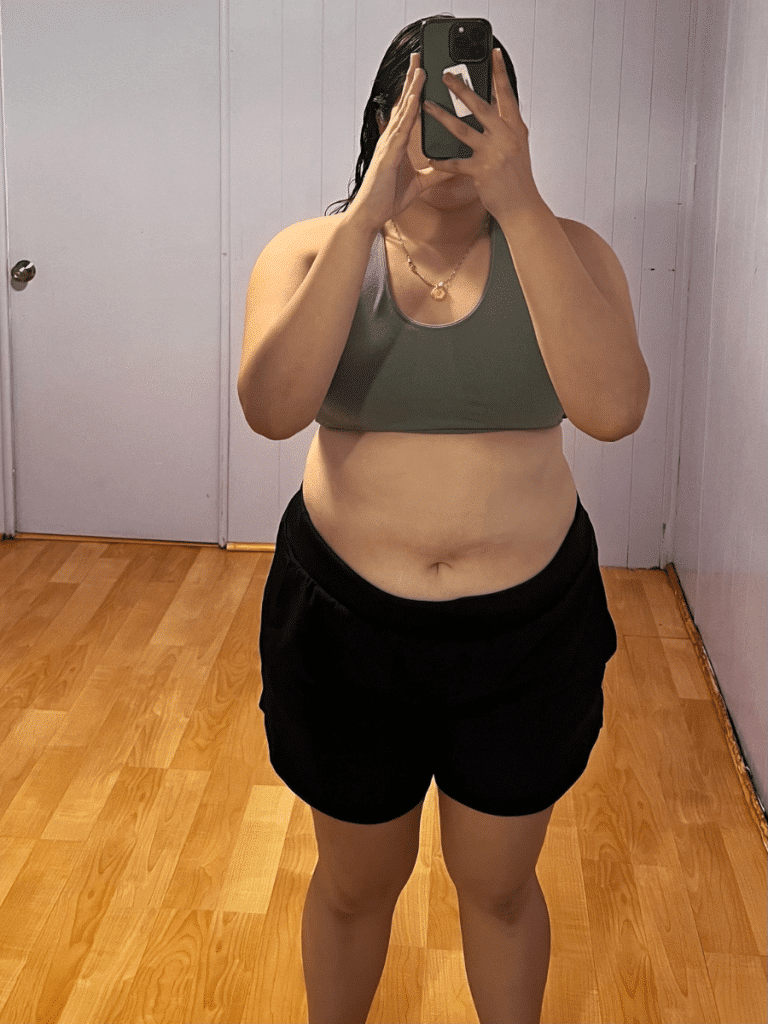 Evelyn before Sleeve Gastrectomy