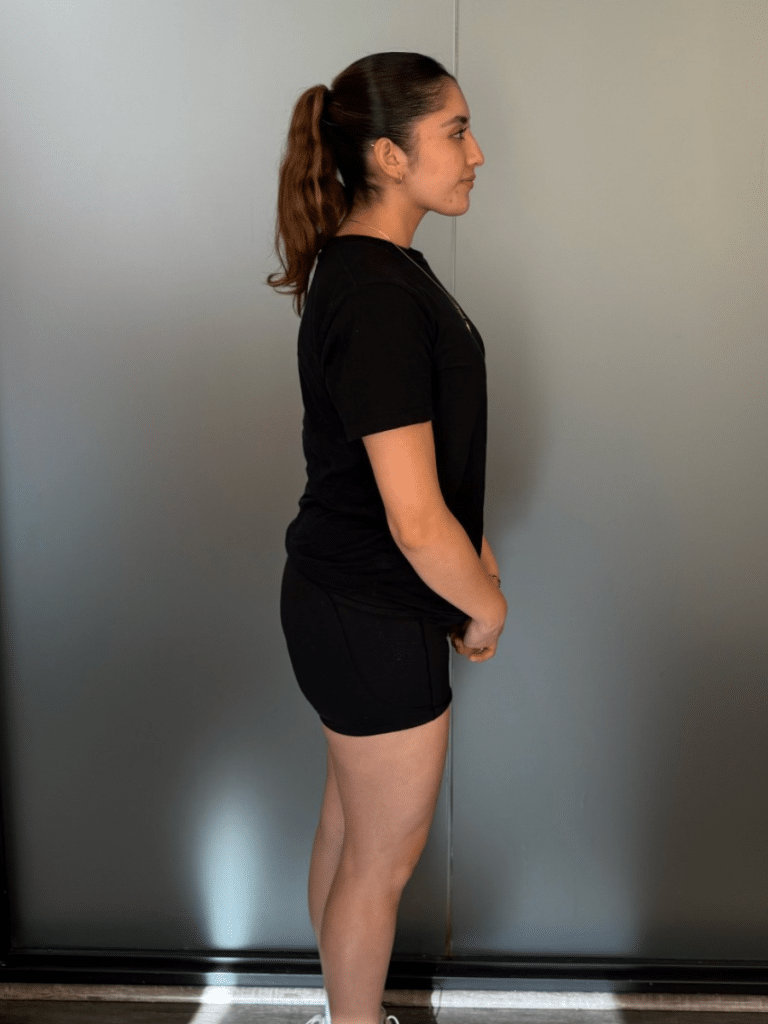 Evelyn after Sleeve Gastrectomy