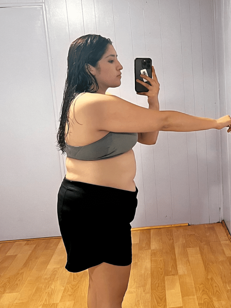 Evelyn before Sleeve Gastrectomy