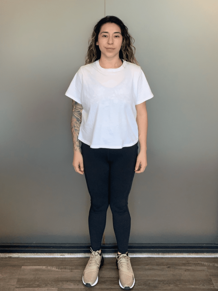 Evelyn after Sleeve Gastrectomy