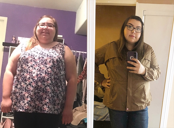 Gastric Band (Lap Band) before-and-after result