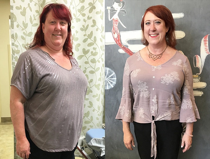 Gastric Band (Lap Band) before-and-after result