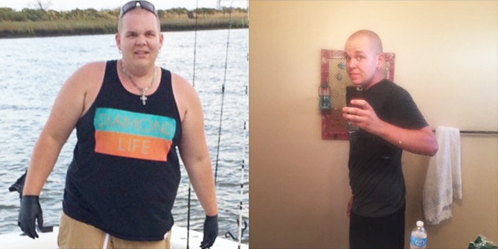 Gastric Bypass before-and-after result