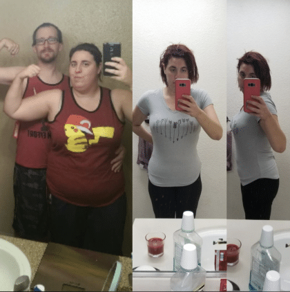 Gastric Balloon before-and-after result