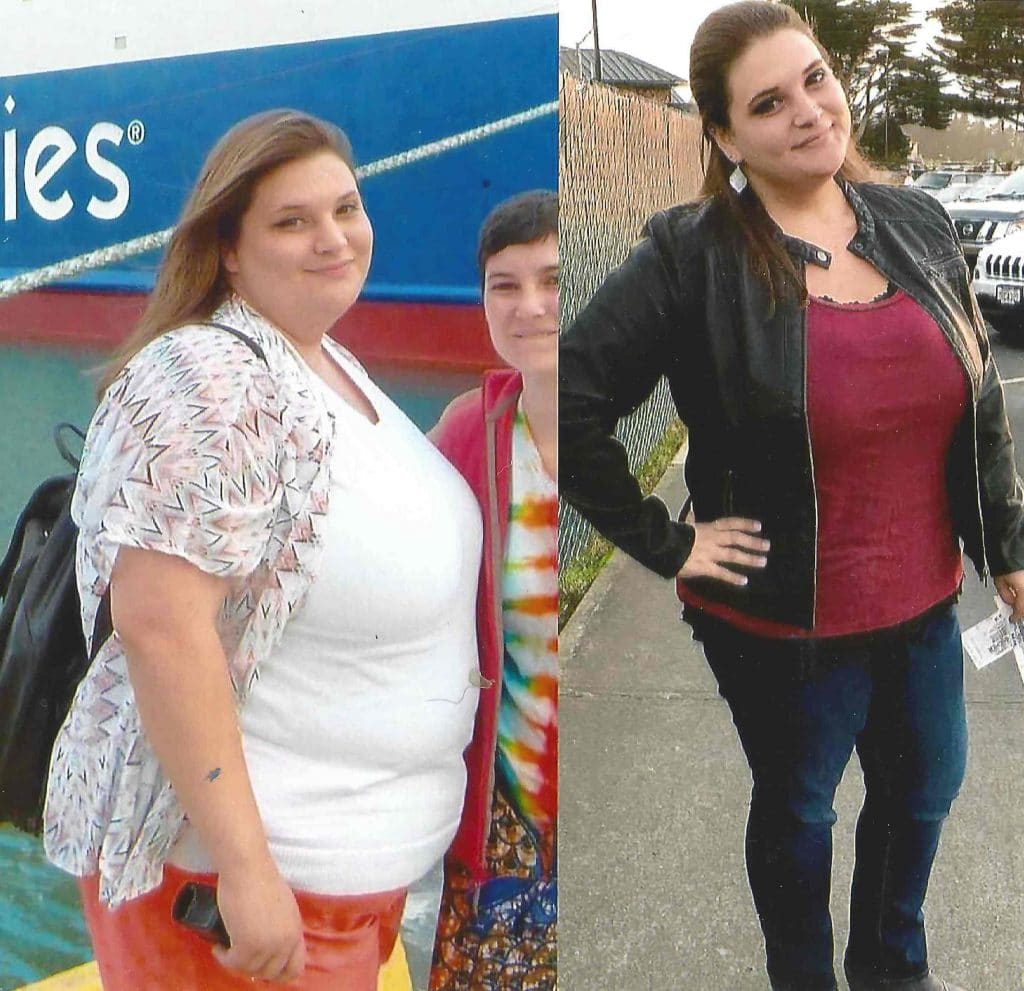 Gastric Balloon before-and-after result