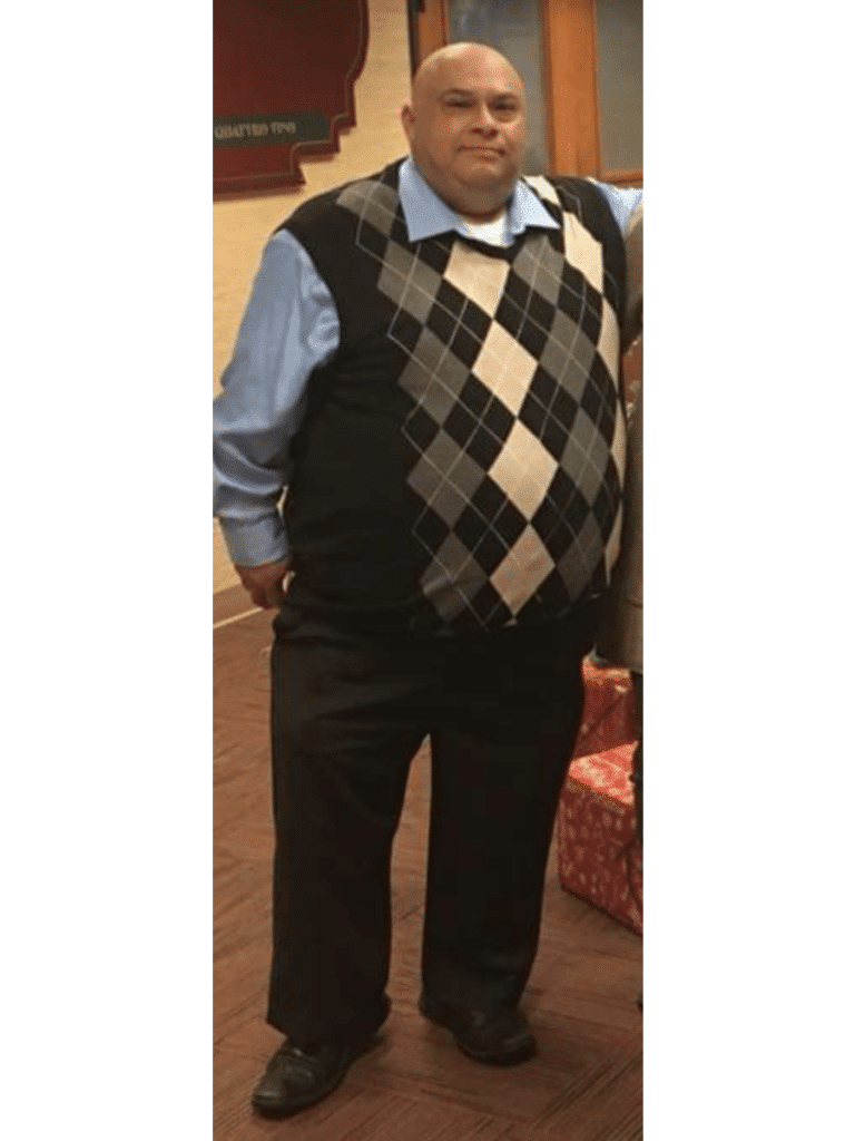 Paul before Sleeve Gastrectomy