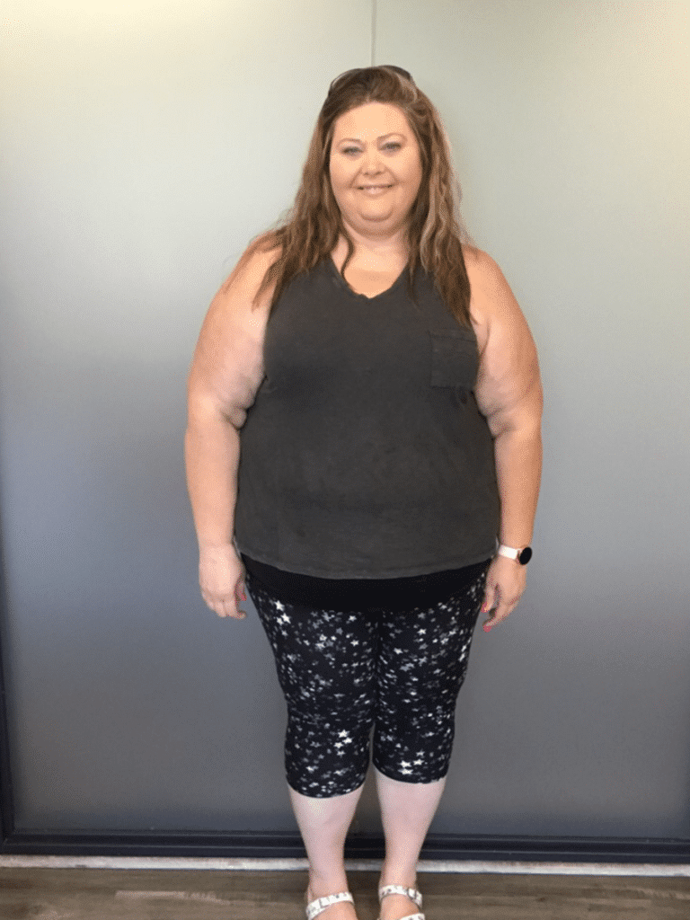 Pauline before Sleeve Gastrectomy