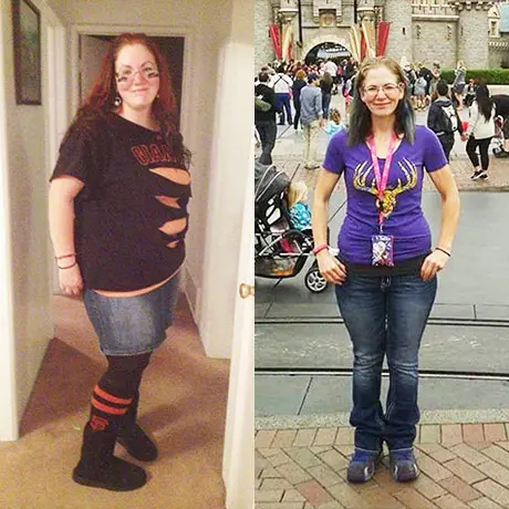 Anonymous patient before and after bariatric surgery