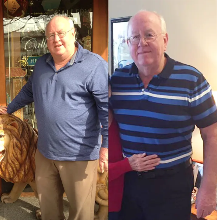 Anonymous patient before and after bariatric surgery